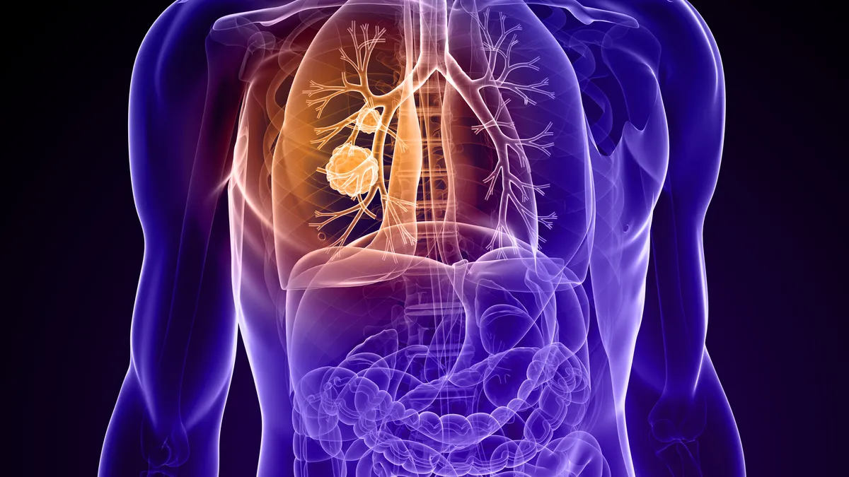 Illustration of lung cancer