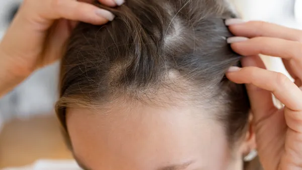An unrecognizable woman has problems with hair and scalp