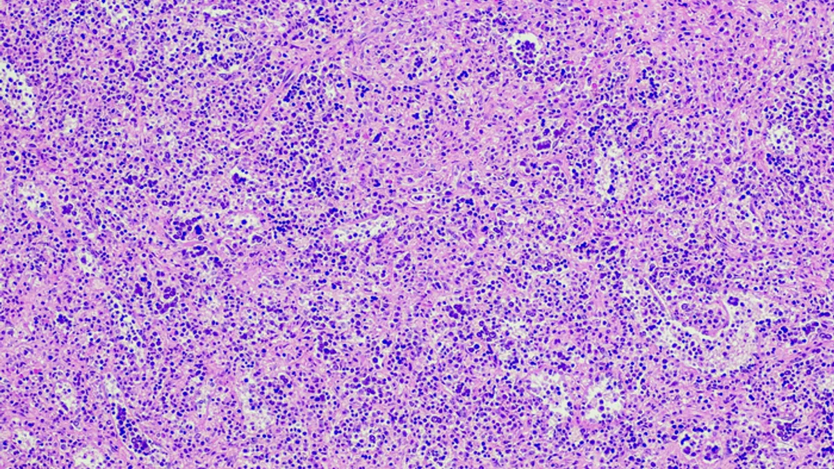 Primary myelofibrosis with extramedullary hematopoiesis. Site: Spleen. Myelofibrosis is a reactive, reversible increase in bone marrow collagen often with extramedullary hematopoiesis (primarily in the spleen).