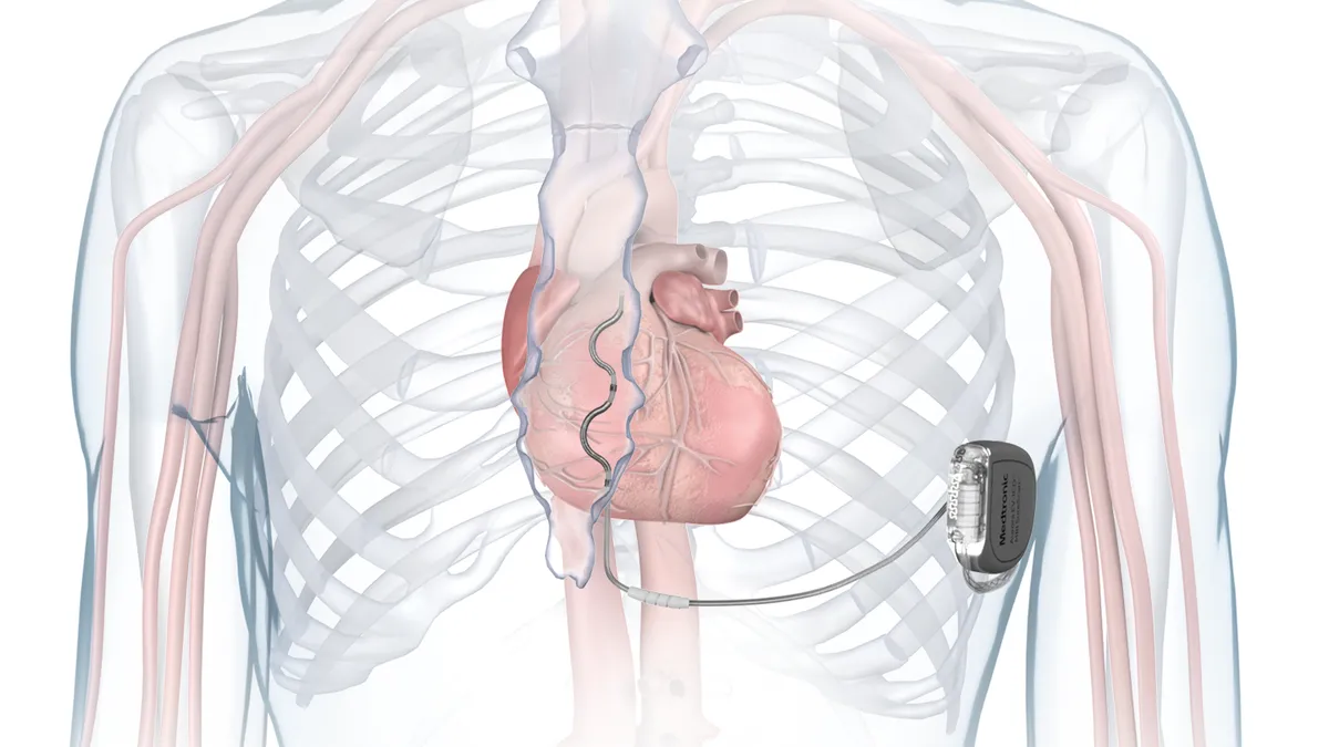 An illustration of the Medtronic Aurora extravascular defibrillator