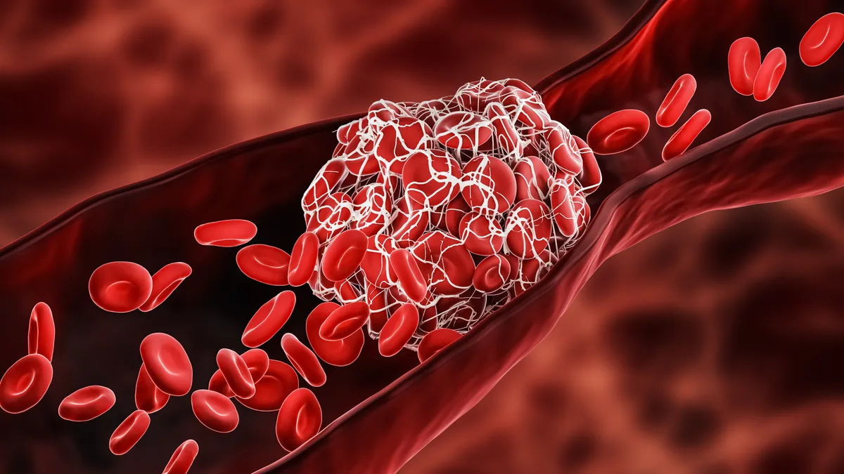 Illustration of a blood clot blocking red blood cells within an artery or a vein.