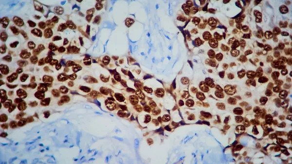 A micrograph of estrogen receptor staining in a breast cancer tumor sample.