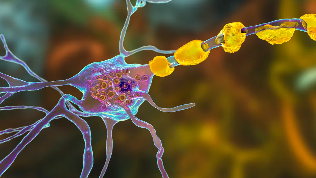 A 3D illustration showing swollen neurons with lamellar inclusions due to accumulation of gangliosides in lysosomes.