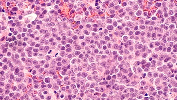 Photomicrograph of a diffuse large B-cell lymphoma (DLBCL) a type of non-Hodgkin lymphoma.