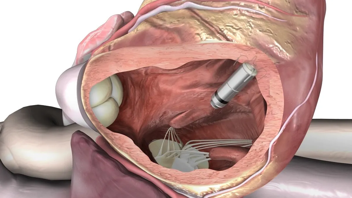 An illustration of the battery-shaped Micra leadless pacemaker implanted in a human heart.