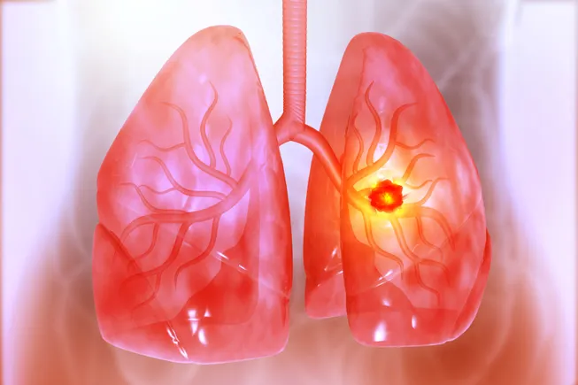 ArriVent collapses on disappointing lung cancer data