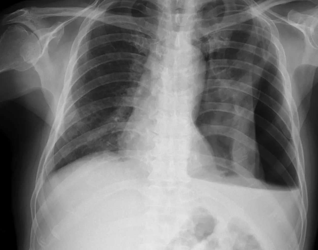 An X-ray image shows the lungs and the ribcage