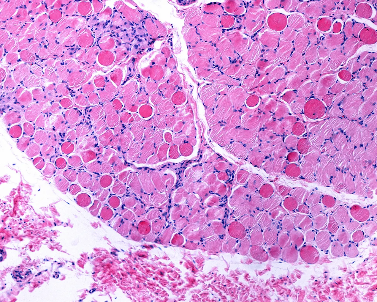An illustration of necrotic muscle fiber in Duchenne muscular dystrophy.