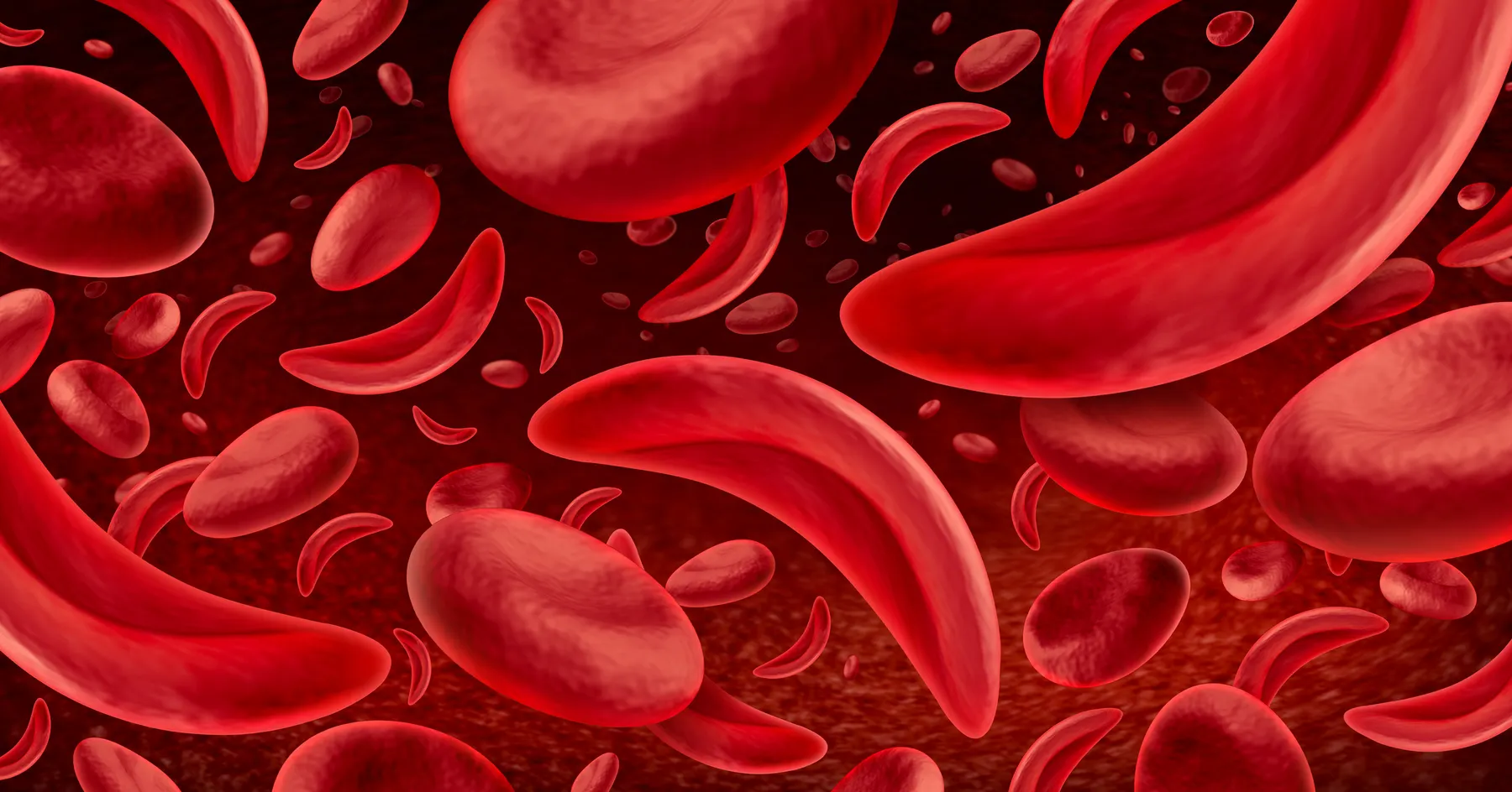 An illustration of sickled and normal red blood cells.