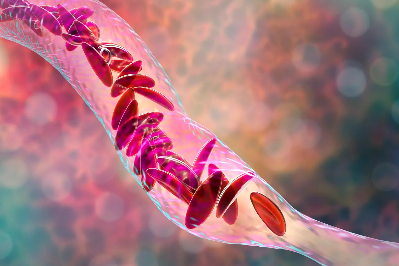 An illustration of sickled red blood cells blocking a blood vessel.
