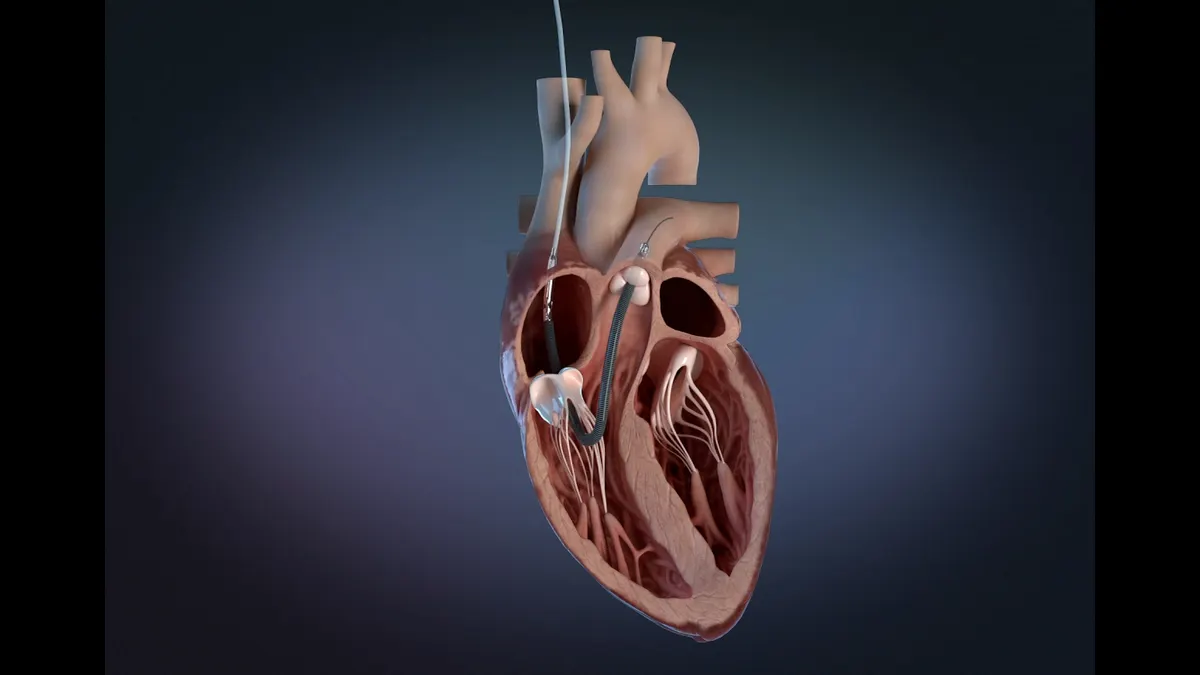 Illustration of a heart with a metal, coiled wire going into it.
