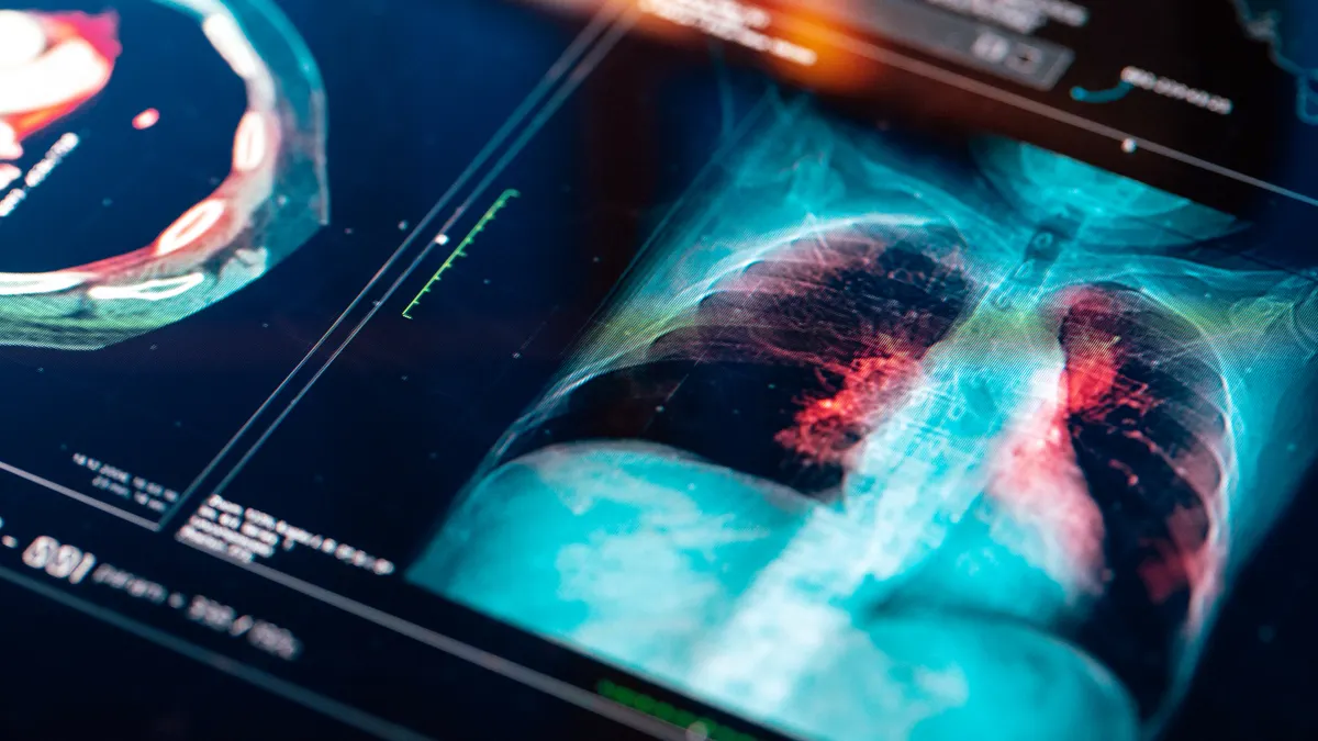 An x-ray of a patient's lungs on a screen