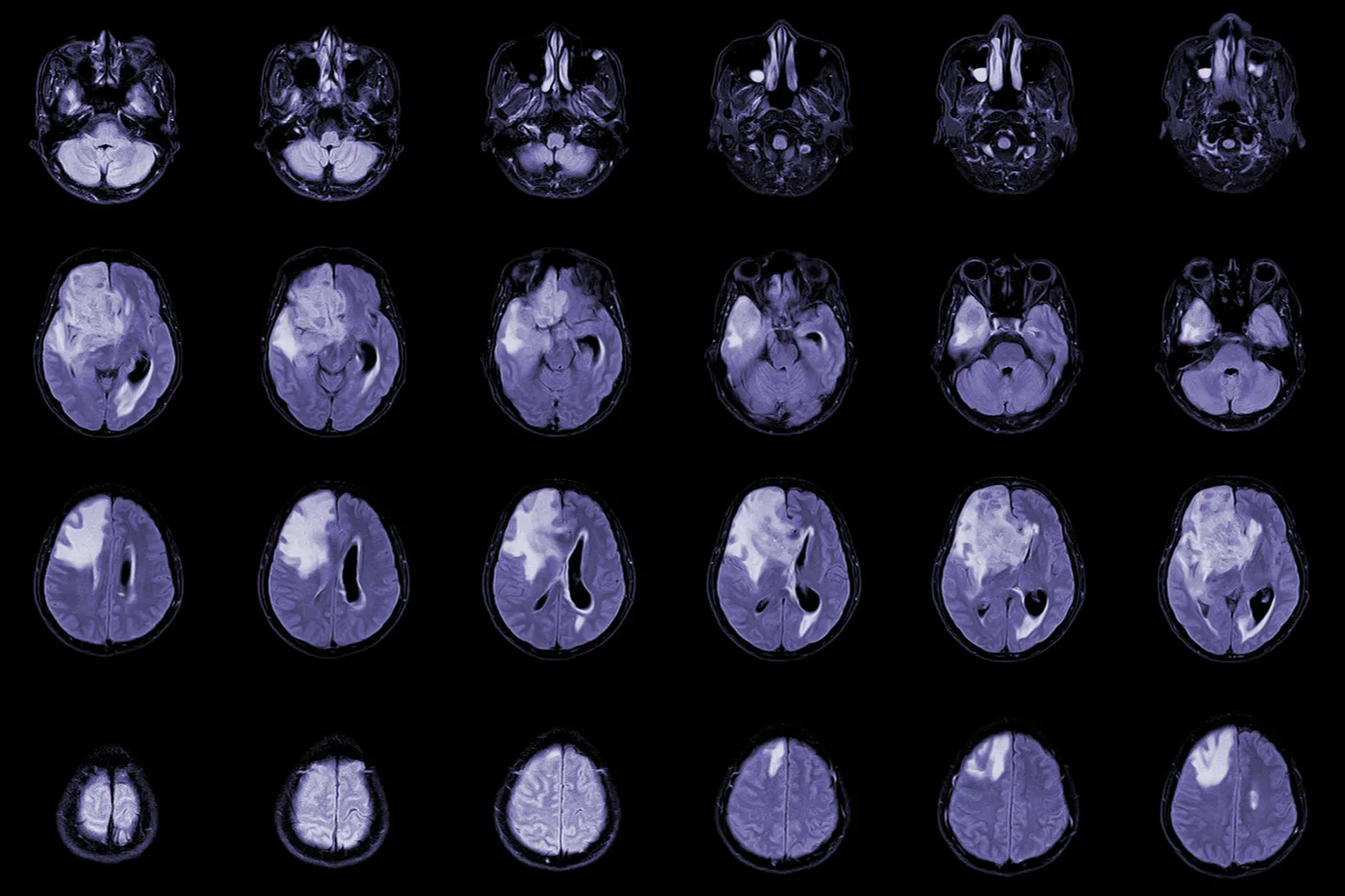 MRI Brain Axial Glioblastoma