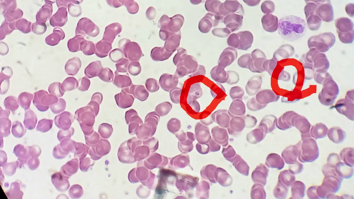 Blood smear on microscopic film shows the malaria parasite Plasmodium falciparum.