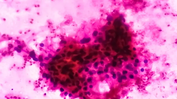 Microscopic image of clear cell carcinoma, the most common type of renal cell carcinoma characterized by cytoplasmic clearing and a pattern of small branching blood vessels.