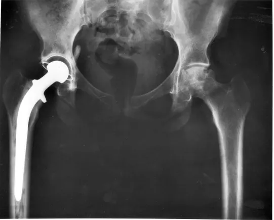 Zimmer Rosa System Zimmer's Rosa total hip system gets FDA nod, fueling robotics rivalry ...