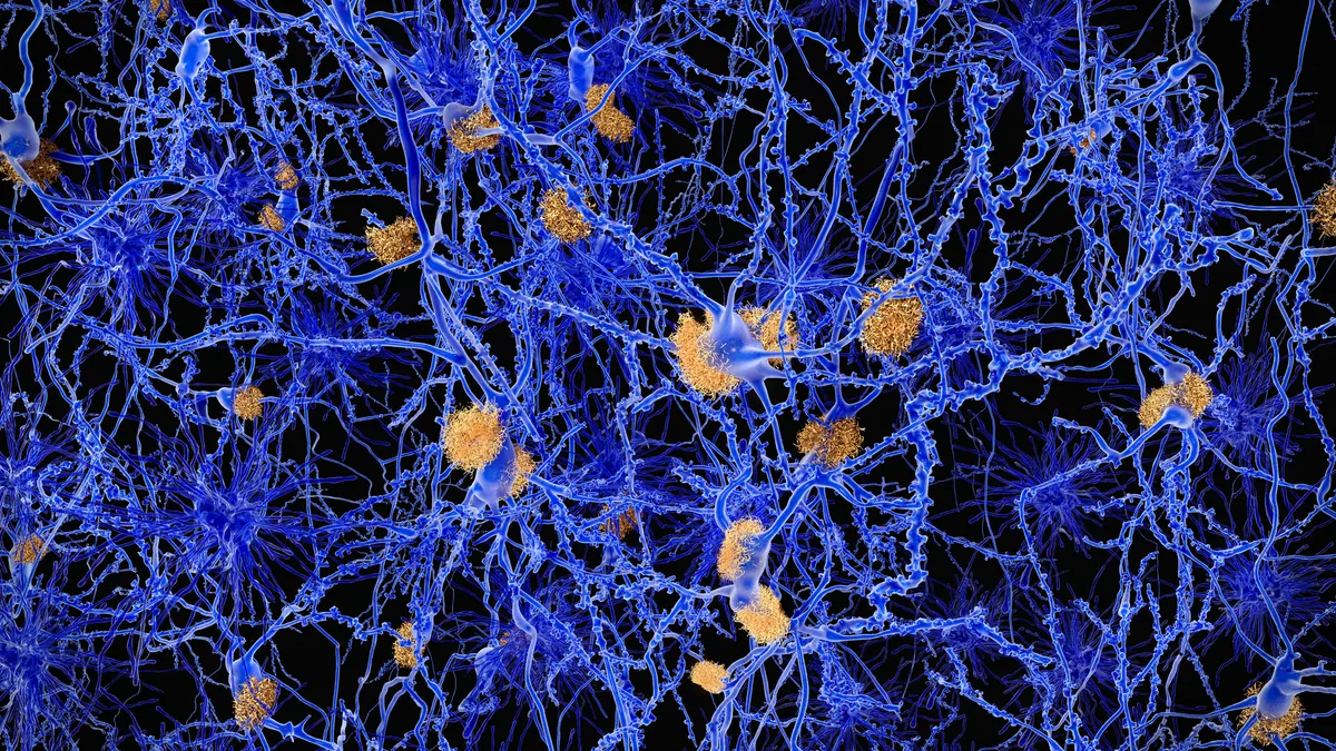 A scientific illustration of amyloid plaques and neurons, colored in blue and orange.