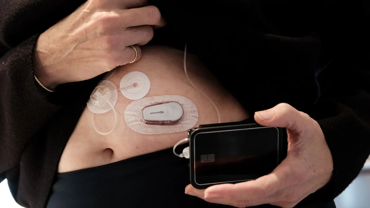 A person holds up their shirt  to show a patch that says "Dexcom G6" on their stomach. They're holding a black, square device with a tube.