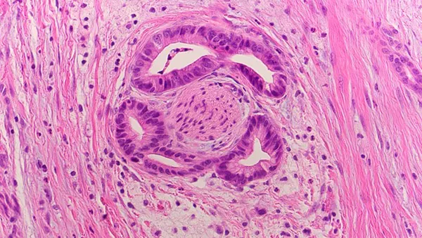 A tissue slide of a cancer specimen.