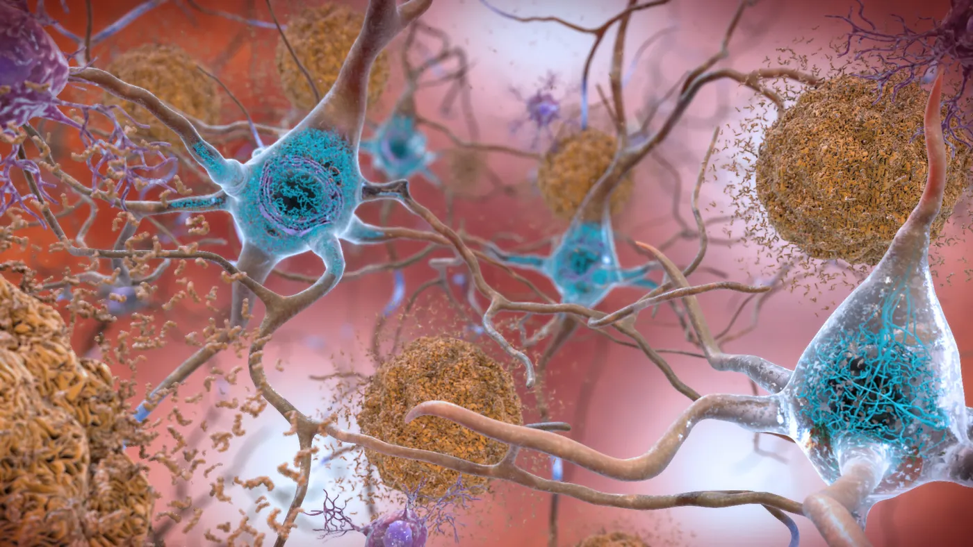 An illustration of beta amyloid plaques and tau in the brain