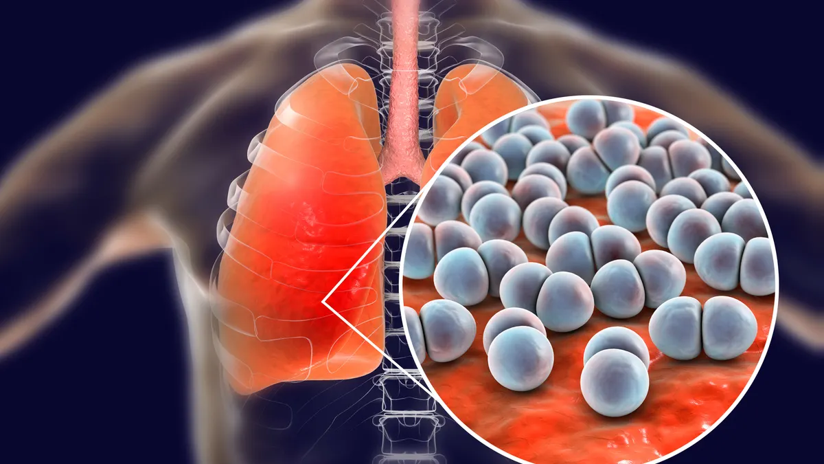 Pneumococcal pneumonia, medical concept - stock photo