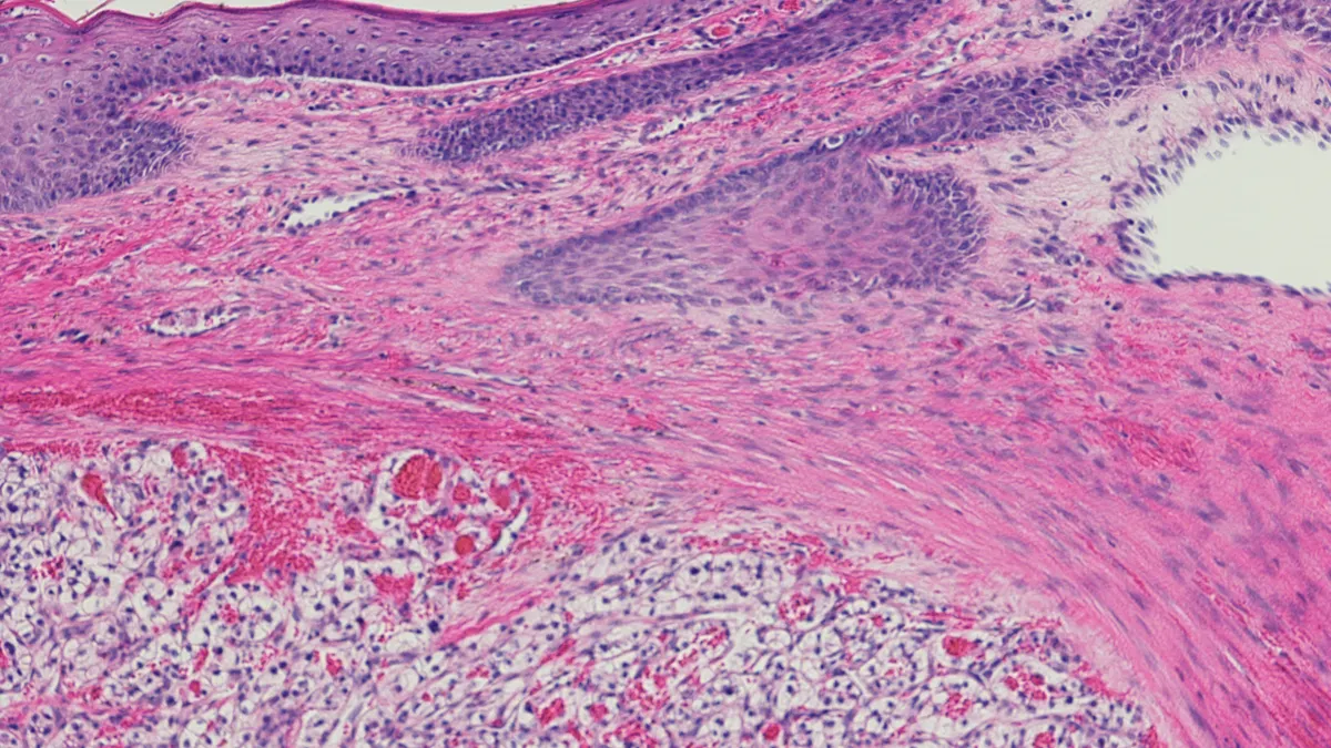 A photo of renal cell carcinoma.