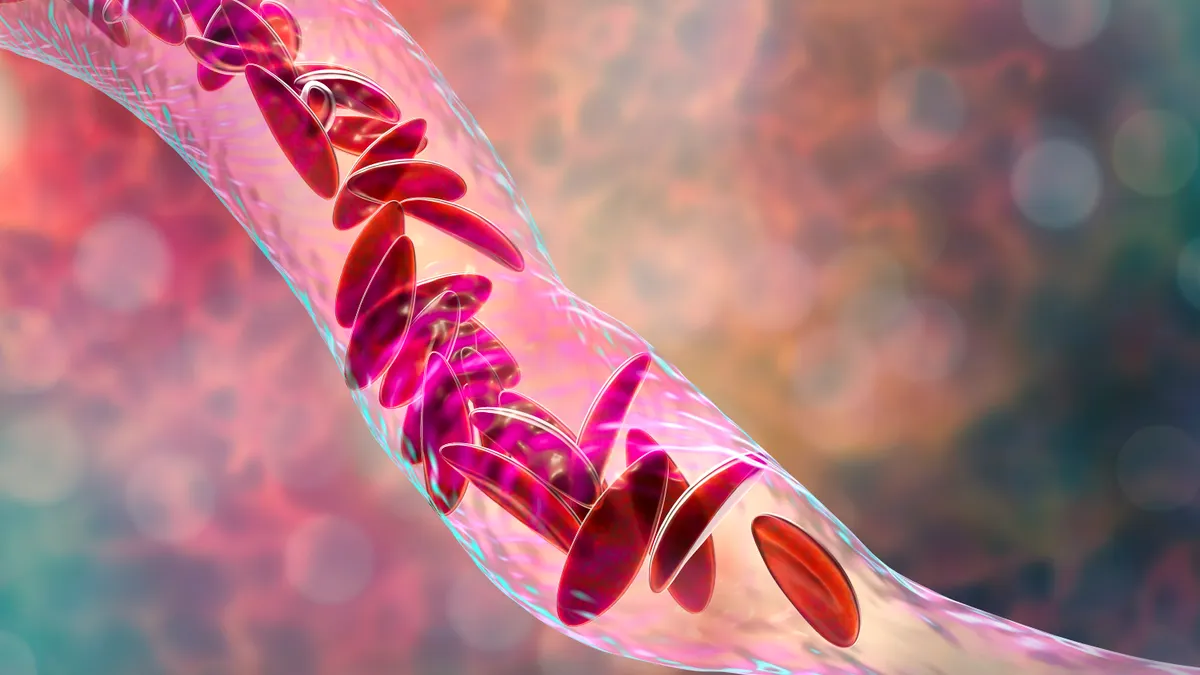 An illustration of sickled red blood cells blocking a blood vessel.