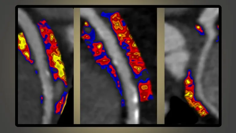 Caristo wins FDA authorization for cardiovascular risk predictor