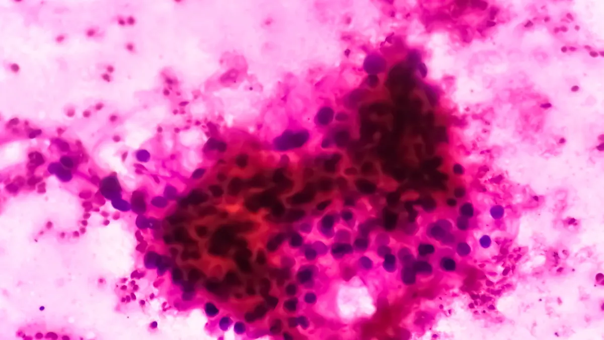 Microscopic image of clear cell carcinoma, the most common type of renal cell carcinoma characterized by cytoplasmic clearing and a pattern of small branching blood vessels.