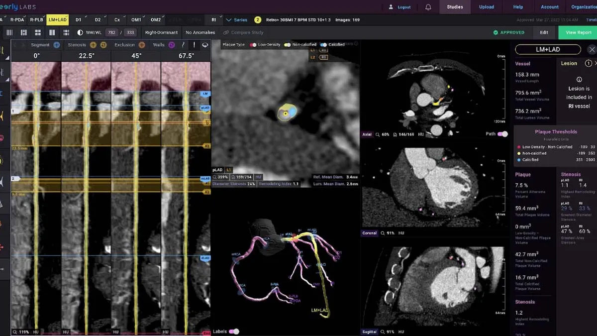 A picture of black and white medical images of a heart on a  computer screen.