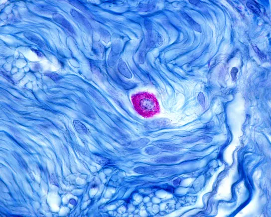 Celldex sinks as safety concerns cloud immune drug results
