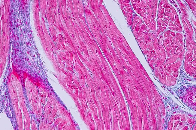Patient dies in trial of Rocket gene therapy for heart condition