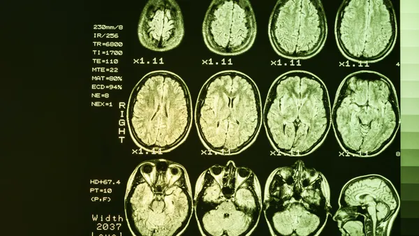MRI Brain scan