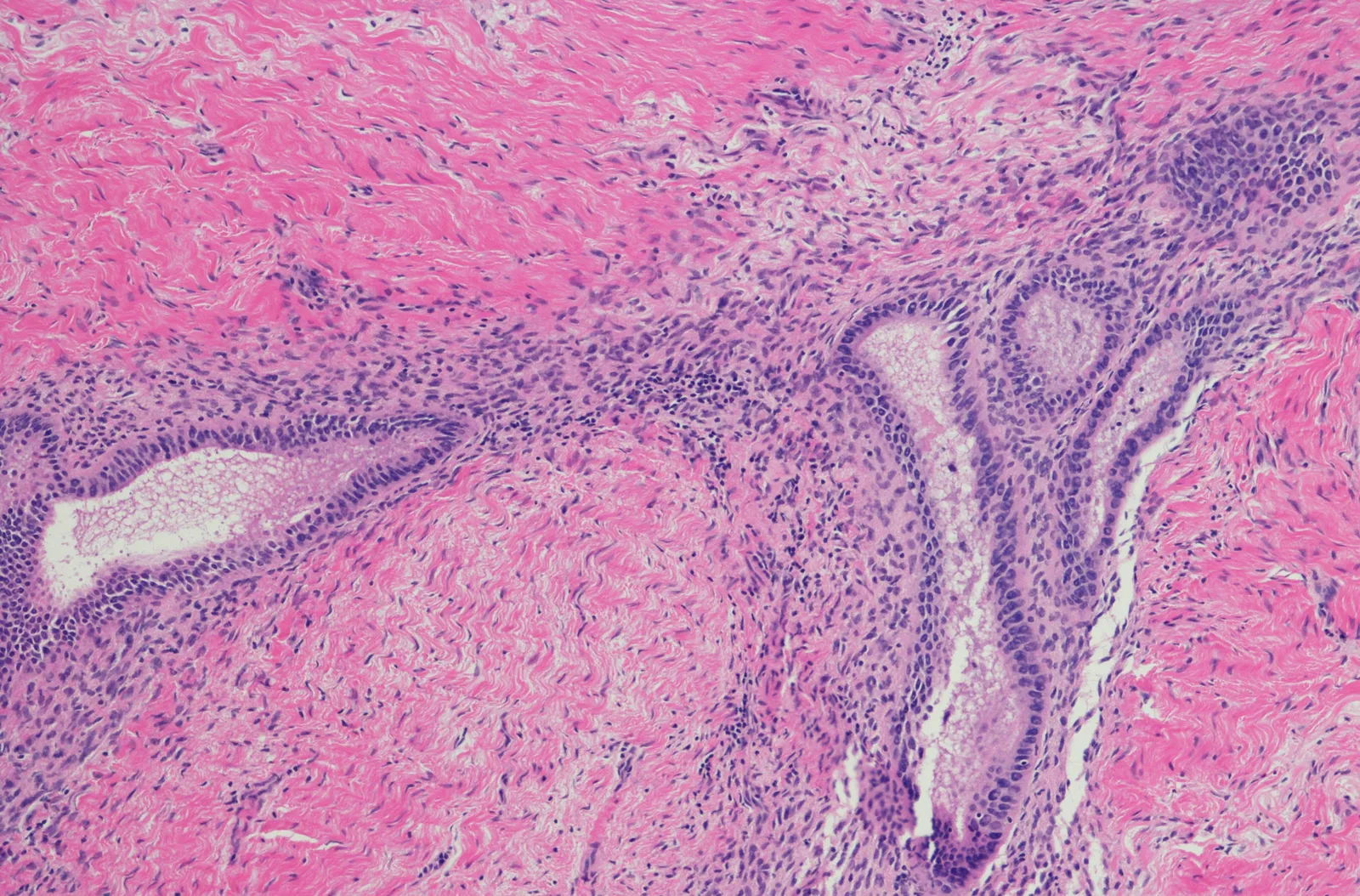 A micrograph of endometrial tissue, stained purple and pink.