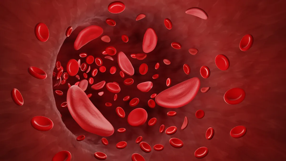 A 3D illustration of sickled cells in blood