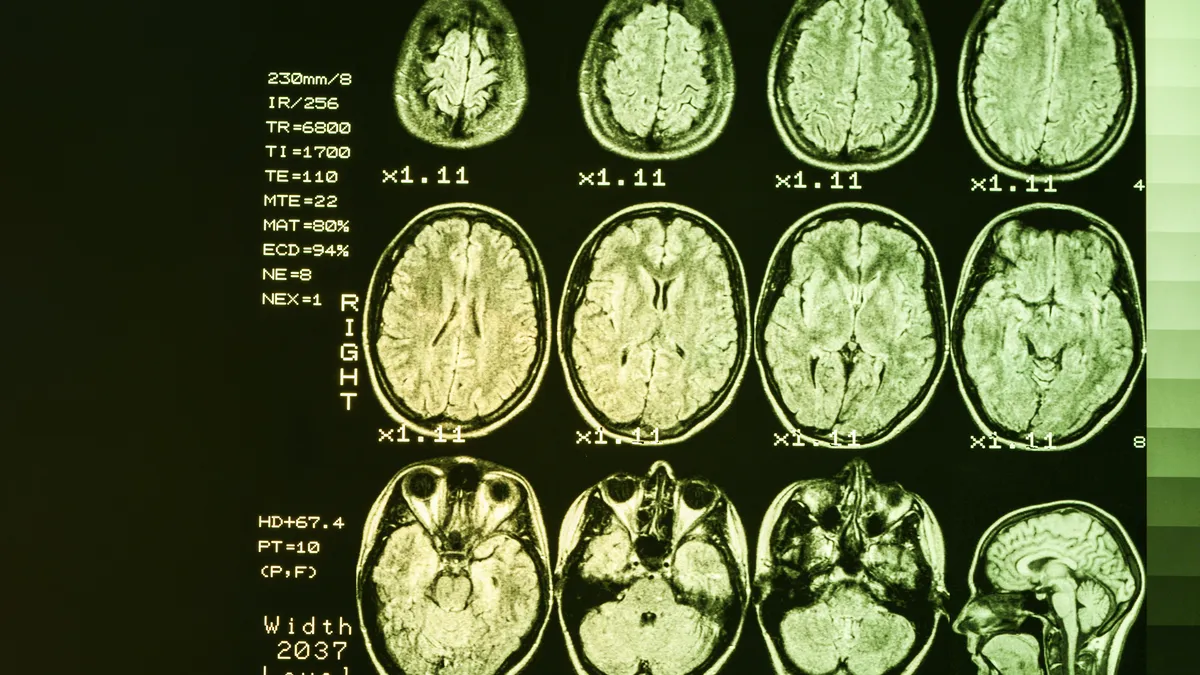 MRI Brain scan