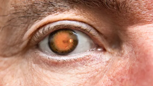 Close up of eye with retina visible