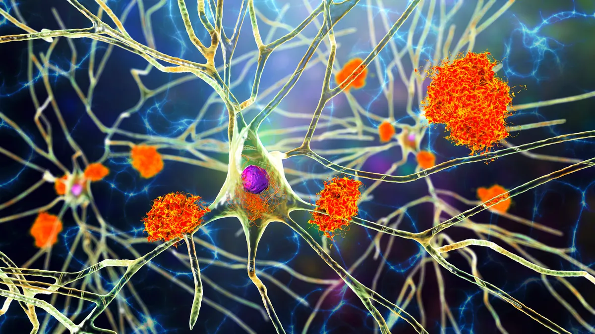 A 3D illustration showing amyloid plaques in brain tissue