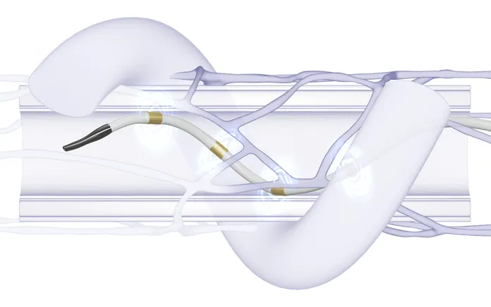 Medtronic data back renal denervation in the long term