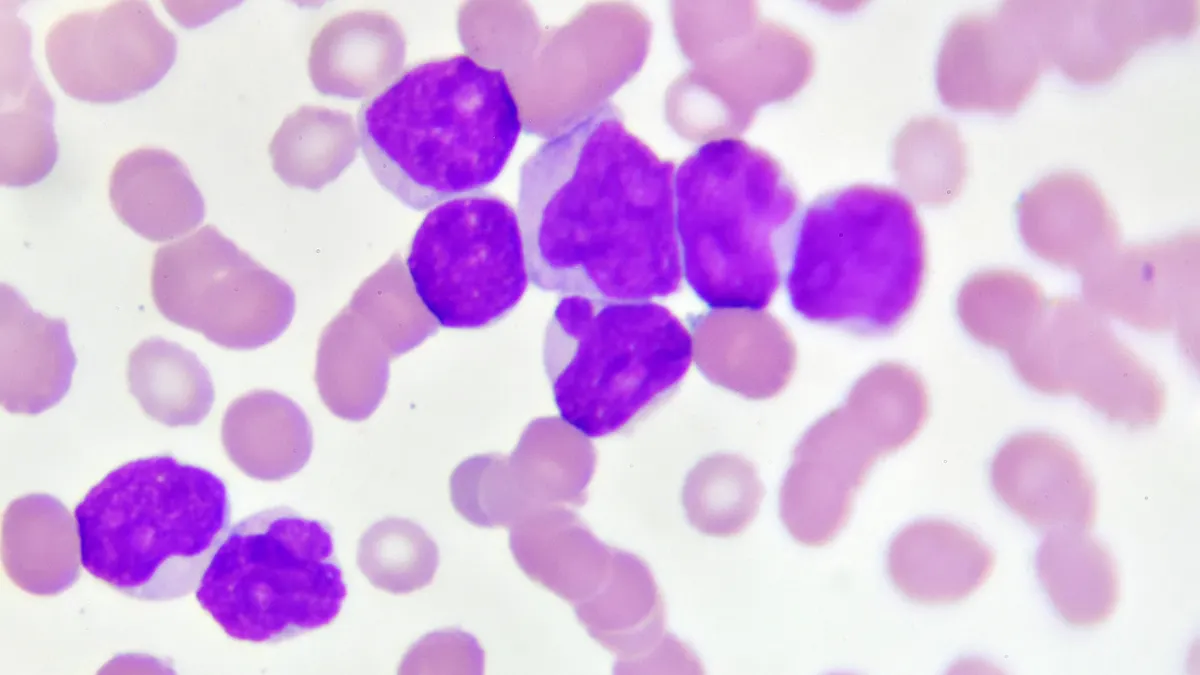A micrograph of acute myeloid leukemic cells